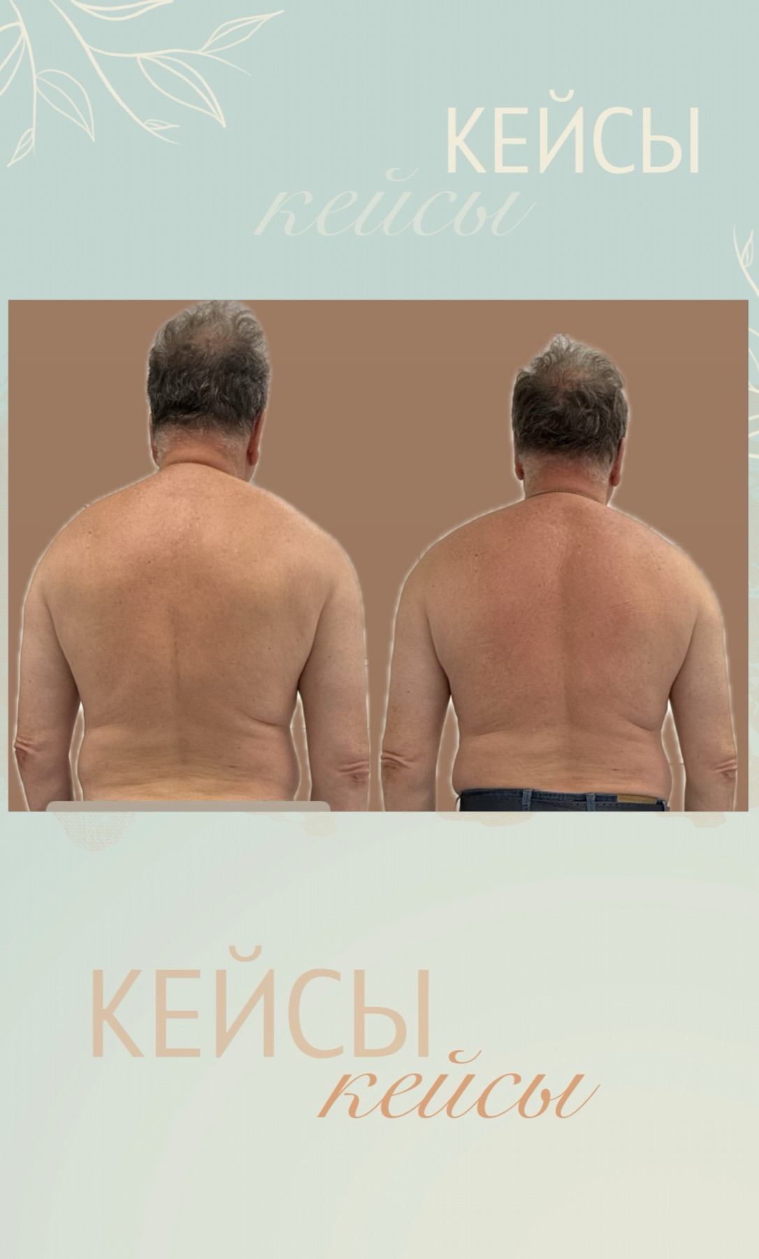 Сравнительные фотографии спины и плеч клиента
